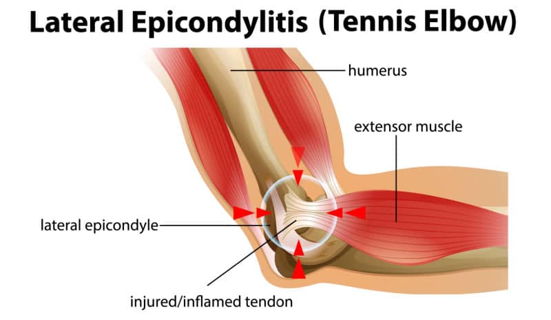 Tennis Elbow Treatment Slough