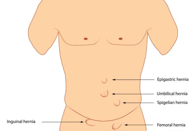 Hernia Ultrasound Scan Marlow