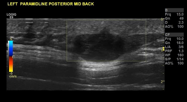 Cyst Lumps and Bumps Berkshire